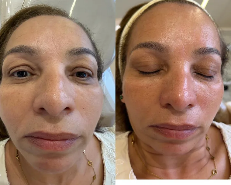 Resultado de tratamento de estética facial, antes e depois de paciente real